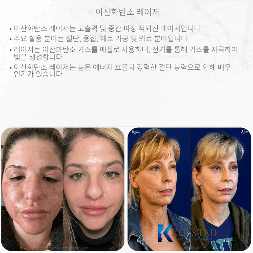 이산화탄소 레이저
